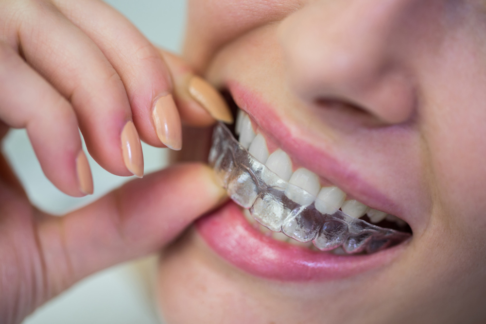 Reabilitação Oral: Como a Inovação Está Transformando Tratamentos 4 aparelho dentista comum invisivel